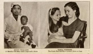 Ripley's Believe It or Not: Betty Williams and Freda Pushnik