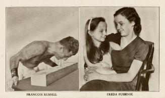 Ripley's Believe It or Not: Francois Russell and Freda Pushnik