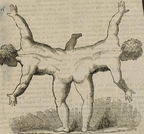 Siamese twins, connected at the waist and buttock