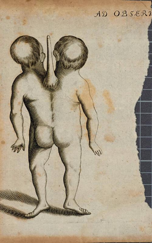 Rear-view of conjoined twins with two heads and one torso