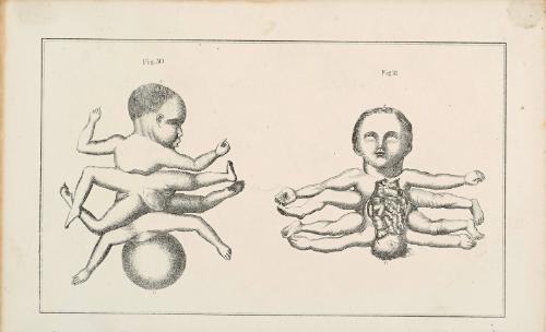 Two views of a conjoined twin infant with four limbs