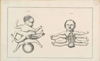 Two views of a conjoined twin infant with four limbs