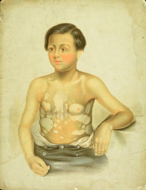 Boy with Leucoderma